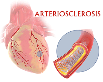 Arteriosclerosis