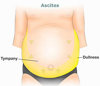 Ascites