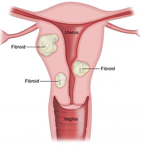 Fibroids