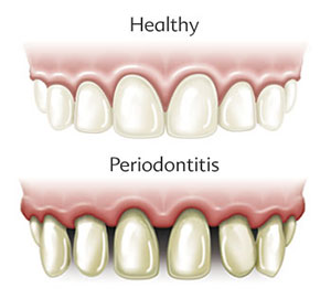 Gum Diseases