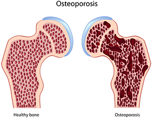 Osteoporosis