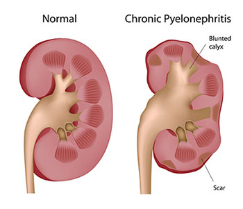 Pyelonephritis