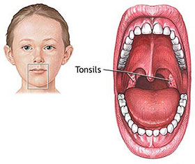 Tonsillitis - How to get rid of tonsils fast in children