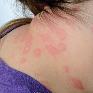 Urticaria