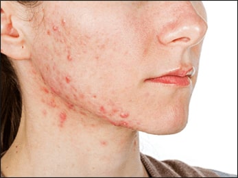 Acne, Herbal Remedies for Acne