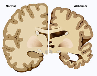 Alzheimer Disease