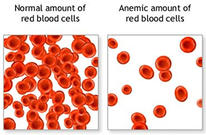 Anemia