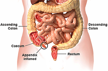 Appendicitis