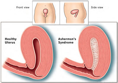 Asherman's syndrome