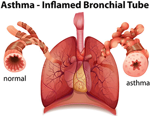 Asthma