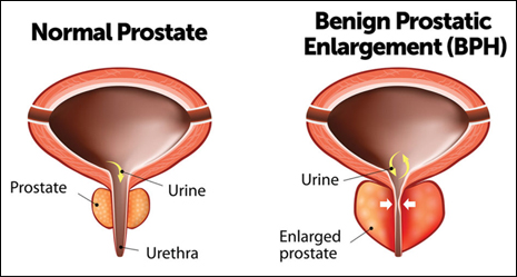 Benign prostatic hyperplasia