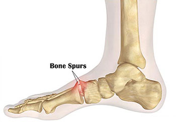 Bone Spur