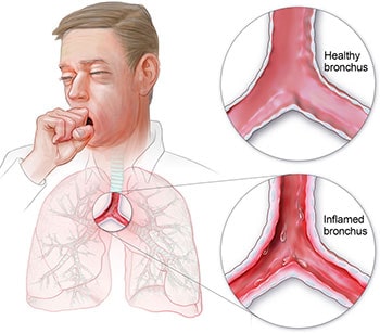 Bronchitis