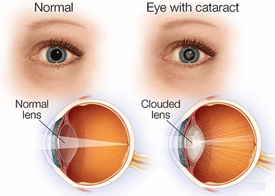 Cataracts