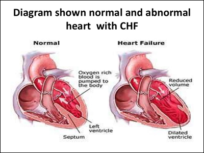 Congestive Heart Failure