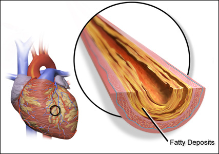 Coronary artery disease