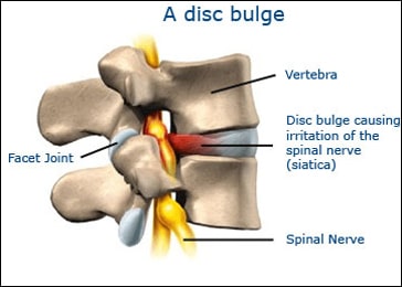 Bulged Disc, herniated disk, protruding disc