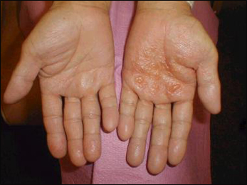 Dyshidrotic Eczema