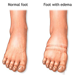  Edema