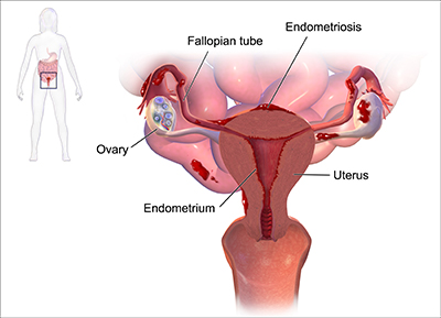 Endometriosis