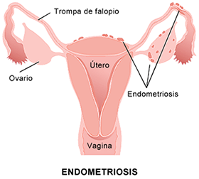 Endometriosis