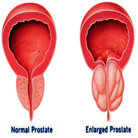 Enlarged Prostate