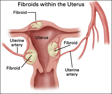 Uterine Fibroids