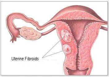 Uterine Fibroids