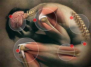 Fibromyalgia