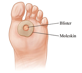 Foot Blisters