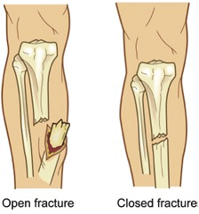 Fracture