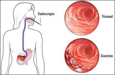 Chronic gastritis