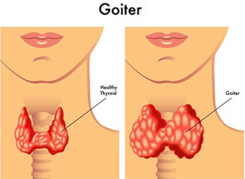 Goiter