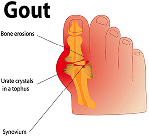 Gout