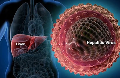 Hepatitis B