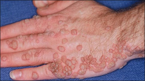 Human Papillomavirus Infection