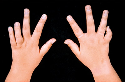 Juvenile Rheumatoid Arthritis (JRA)