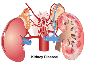 Kidney Diseases