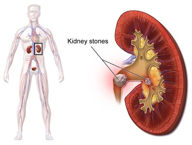 Kidney stones