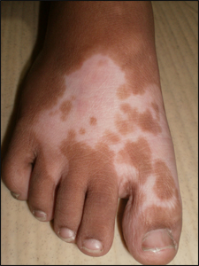 Vitiligo