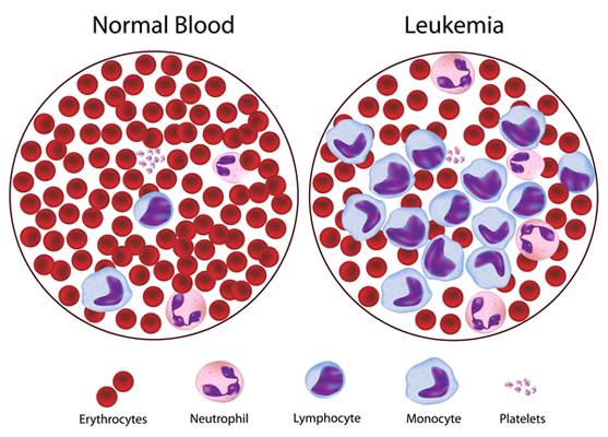 Leukemia