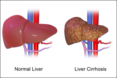 Liver cirrhosis