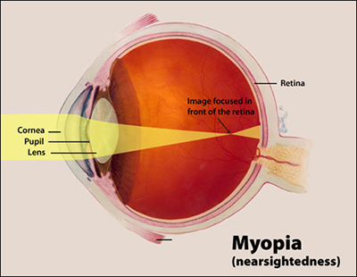 Myopia, Nearsightedness, Shortsightedness