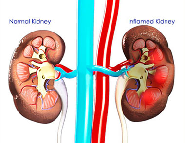 Irritable Bowel Syndrome