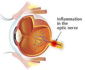 Optic Neuritis