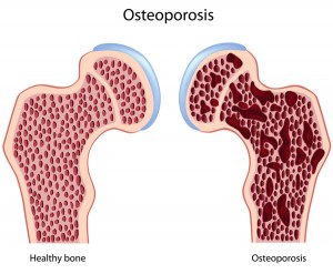 Osteoporosis images