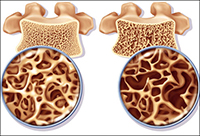 Osteoporosis