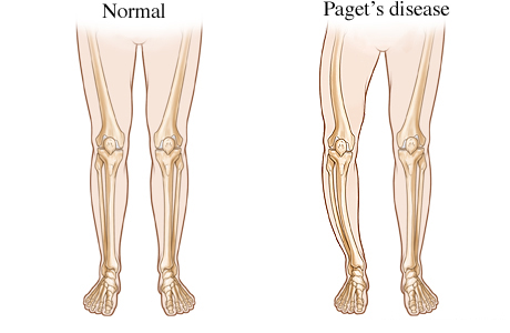 Paget's Disease