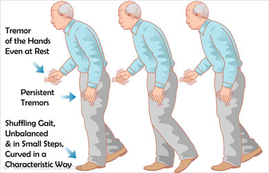 Parkinsonism or Parkinson disease