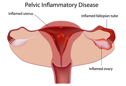 Pelvic Inflammatory Disease